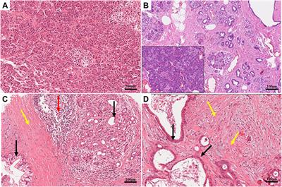 Ion Channels Orchestrate Pancreatic Ductal Adenocarcinoma Progression and Therapy